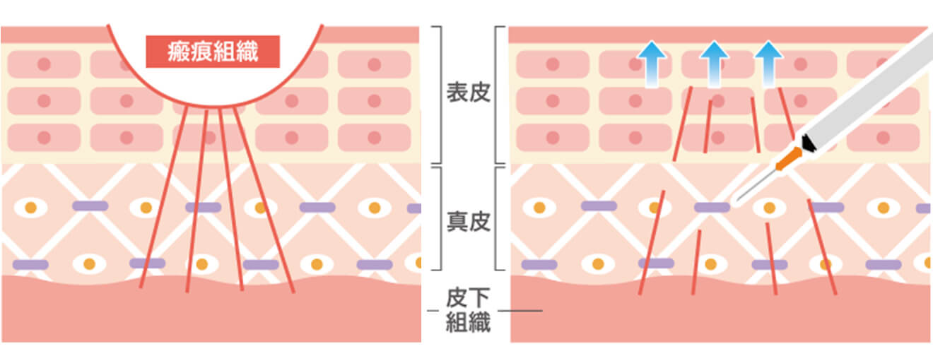 サブシジョン